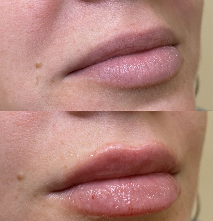 before-after-lip-fillers-1