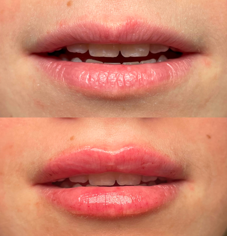 before-after-lip-fillers-2
