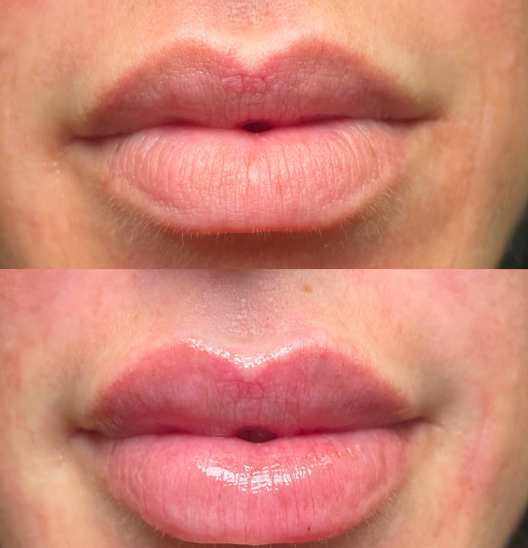 before-after-lip-fillers-3