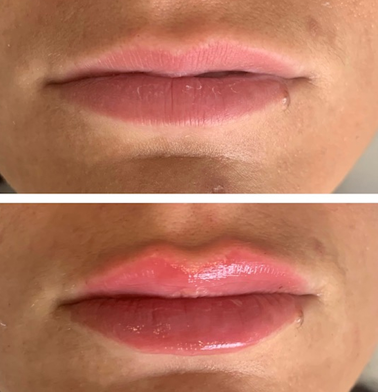 before-after-lip-fillers-4