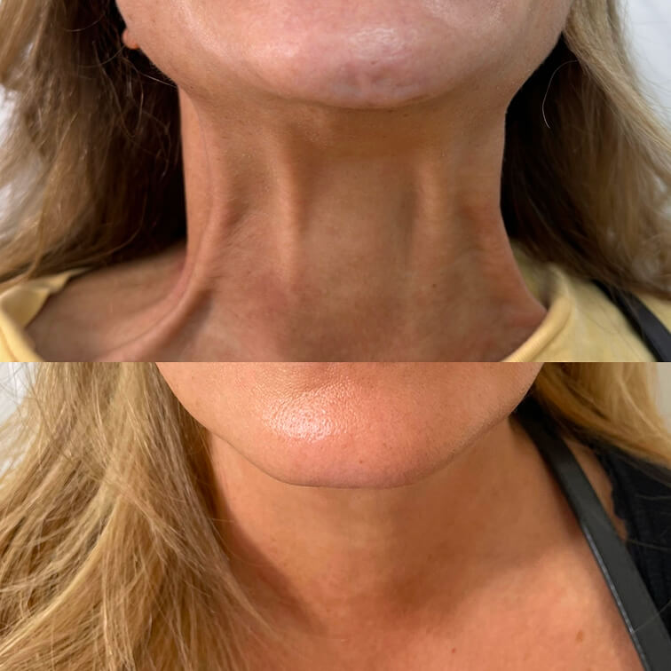 before-after-neurotoxins-1