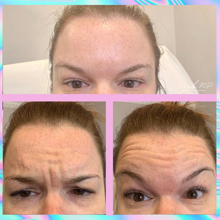 before-after-neurotoxins-2