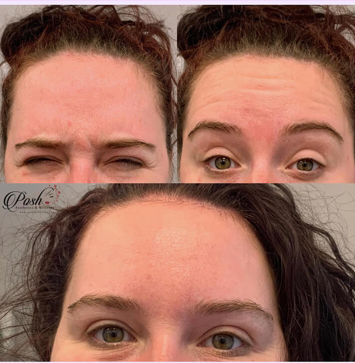 before-after-neurotoxins-3