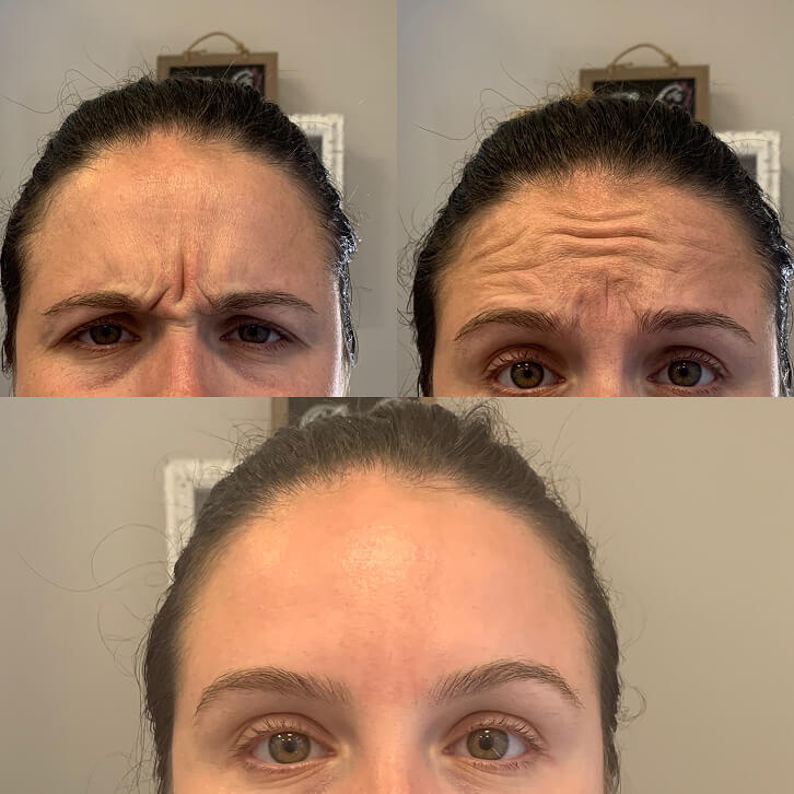 before-after-neurotoxins-4