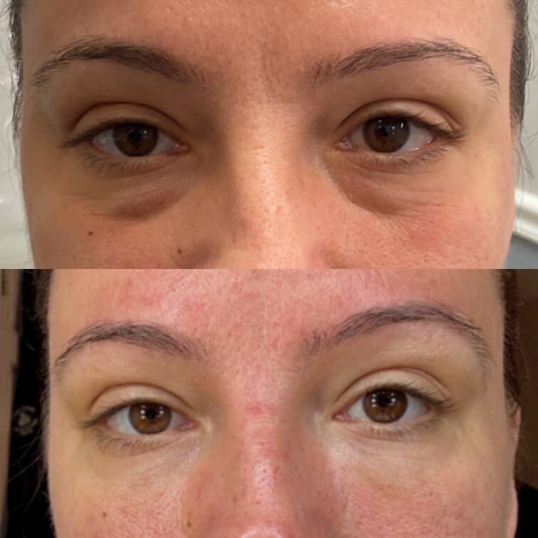 dermal-filler-before-after-1
