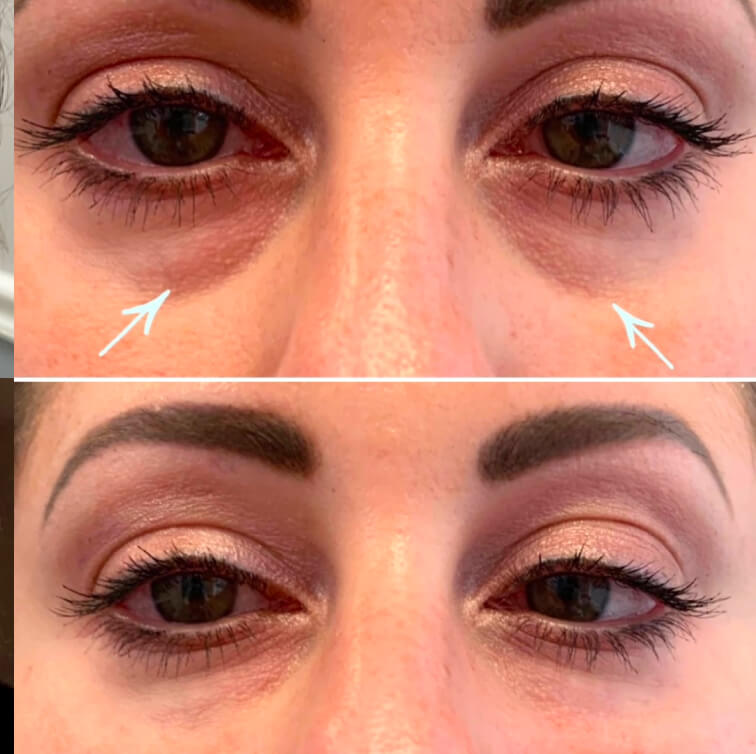 dermal-filler-before-after-2