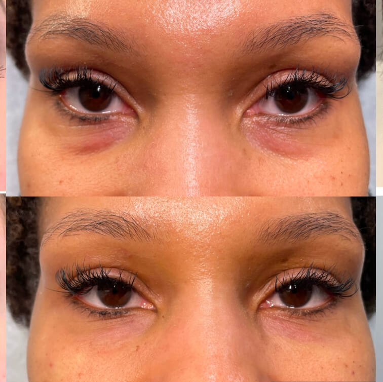 dermal-filler-before-after-3