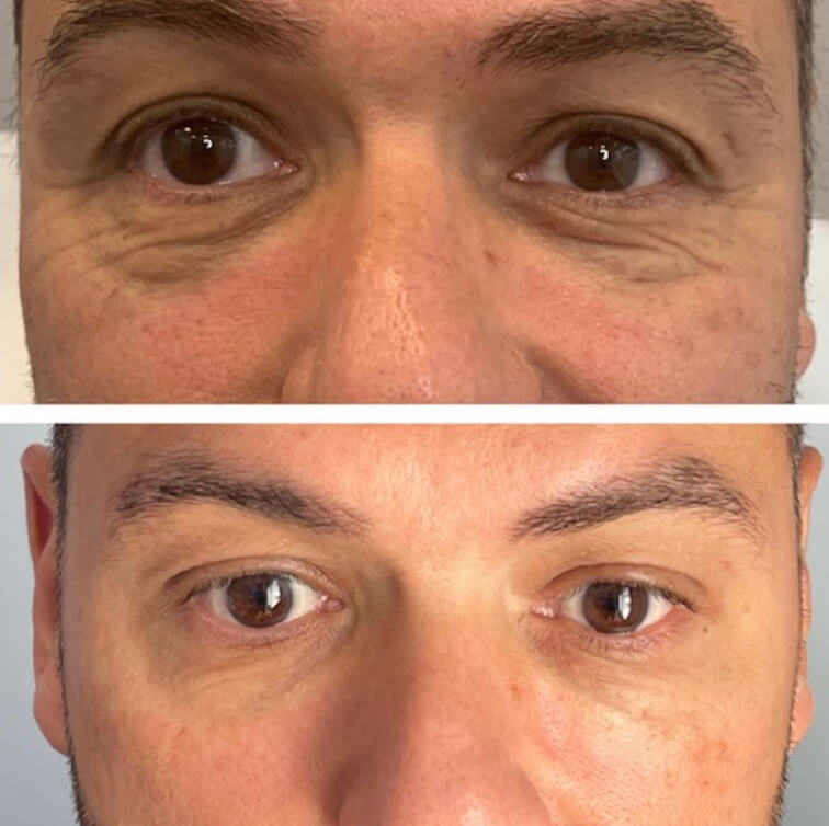 dermal-filler-before-after-4