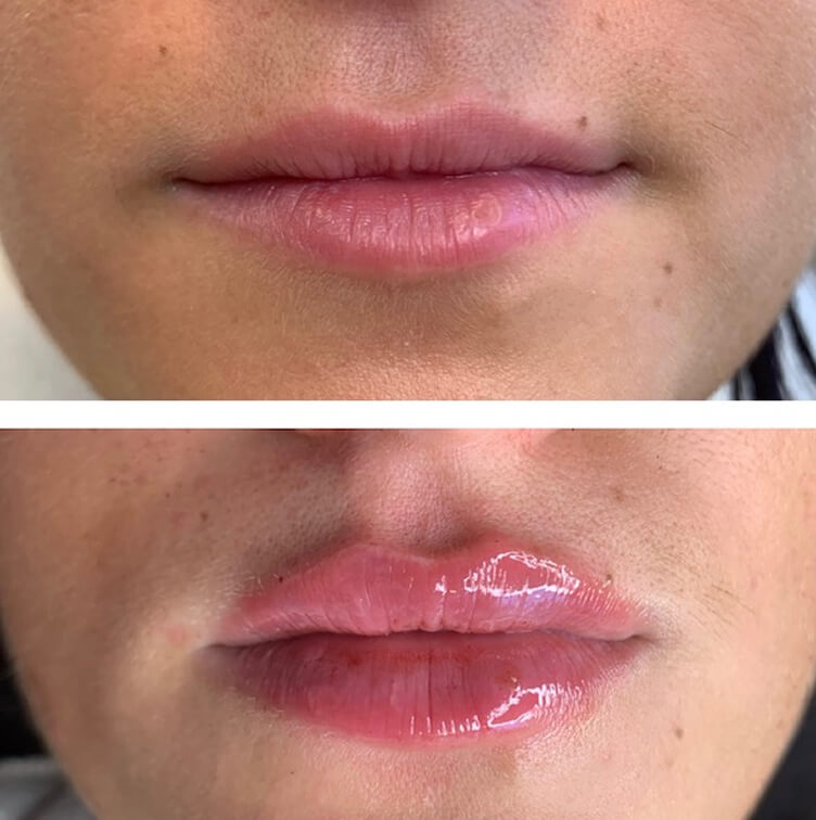 before-after-lip-fillers-6