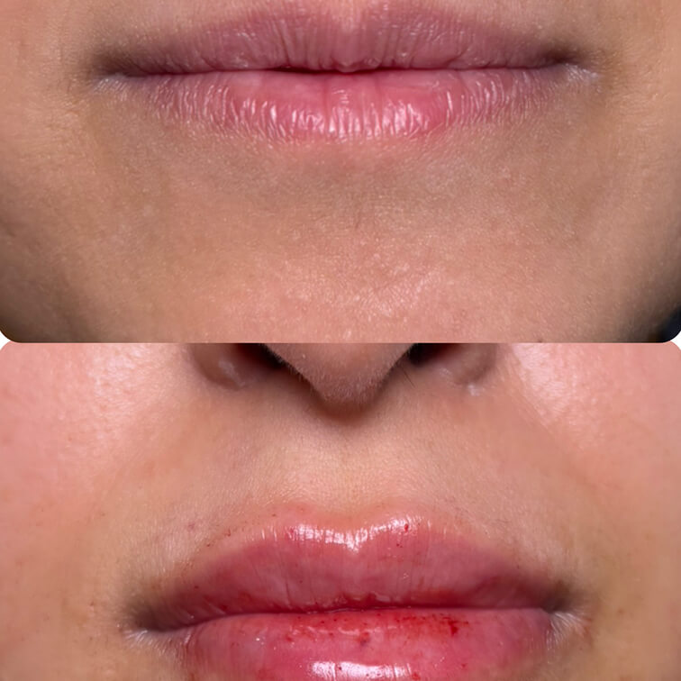 before-after-lip-fillers-7