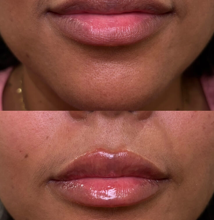 before-after-lip-fillers-8