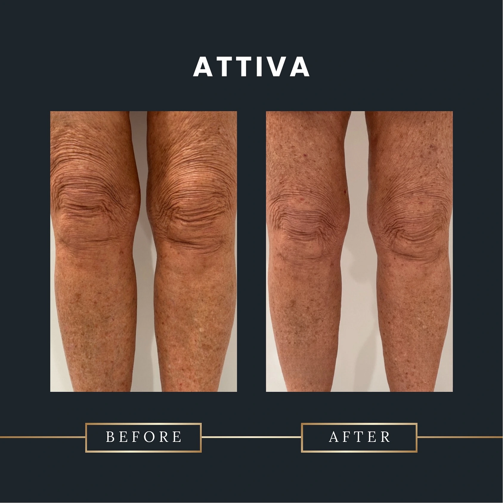 Attiva before and after