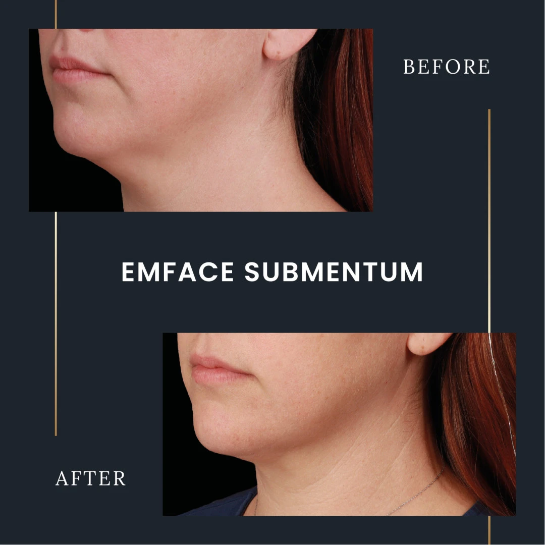 Emface Submentum before and after