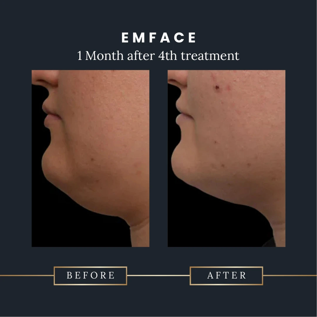 Emface Submentum