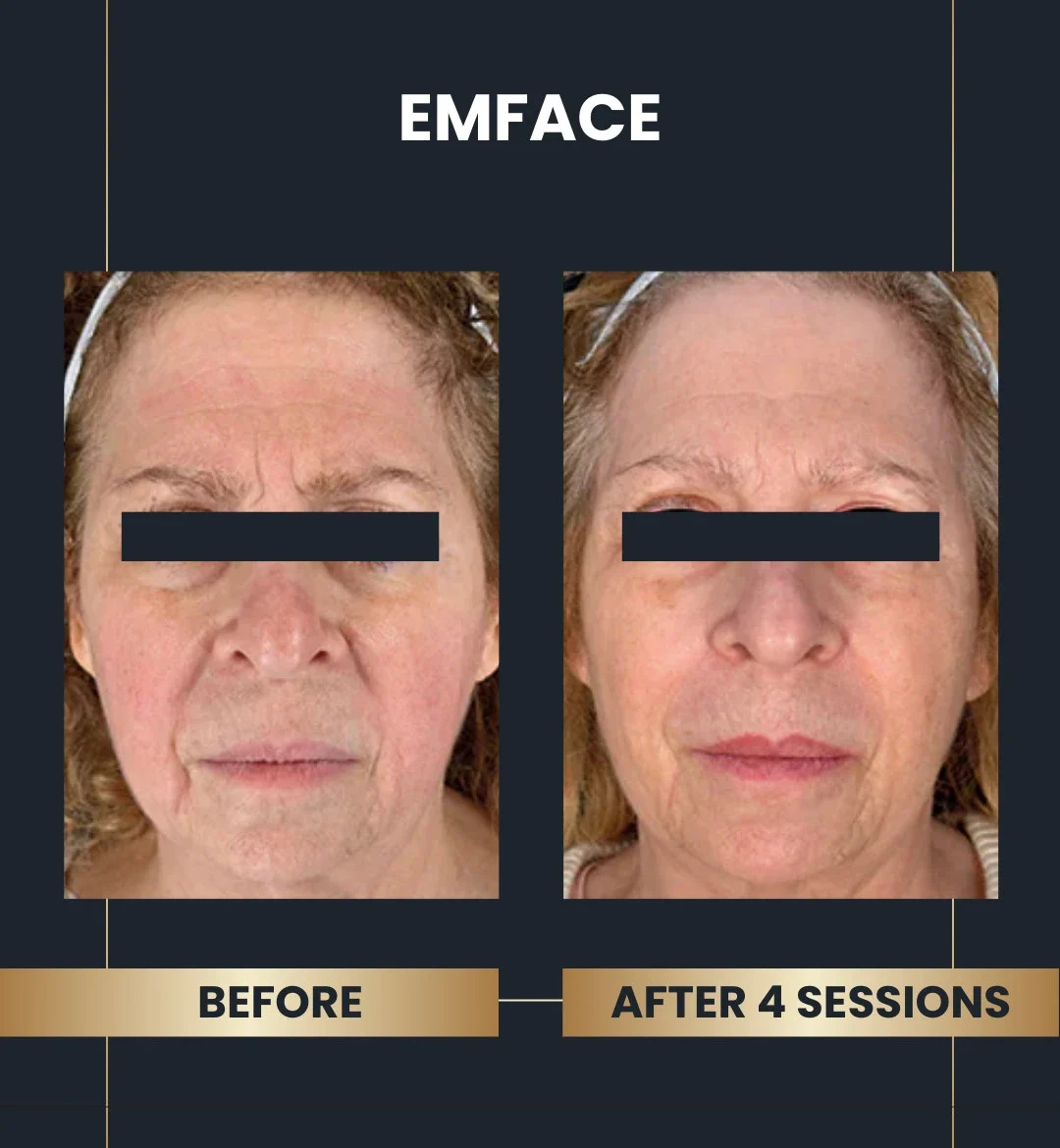 Emface before and after