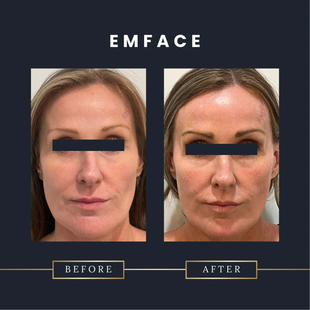 Emface incredible results