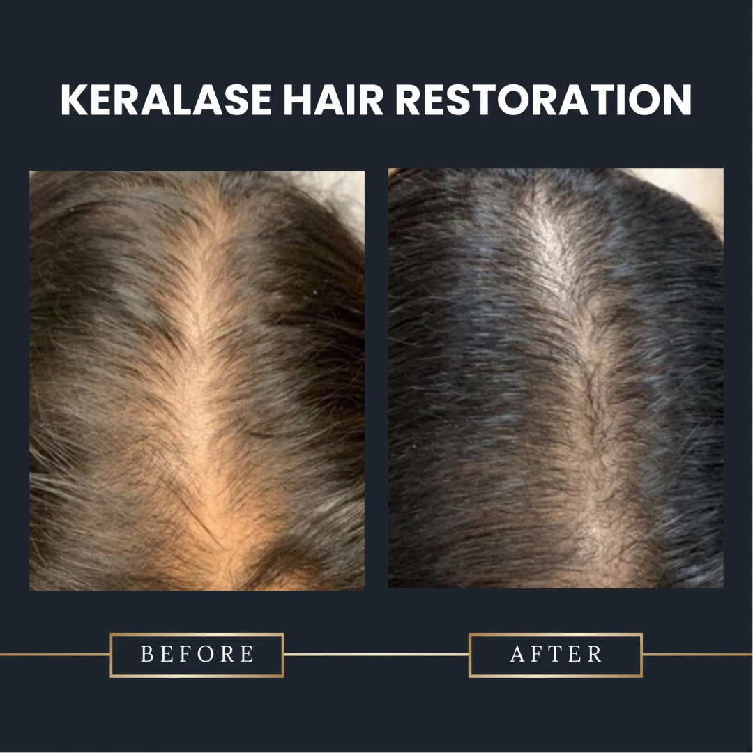 Keralase Hair Restoration treatment in Rye NY