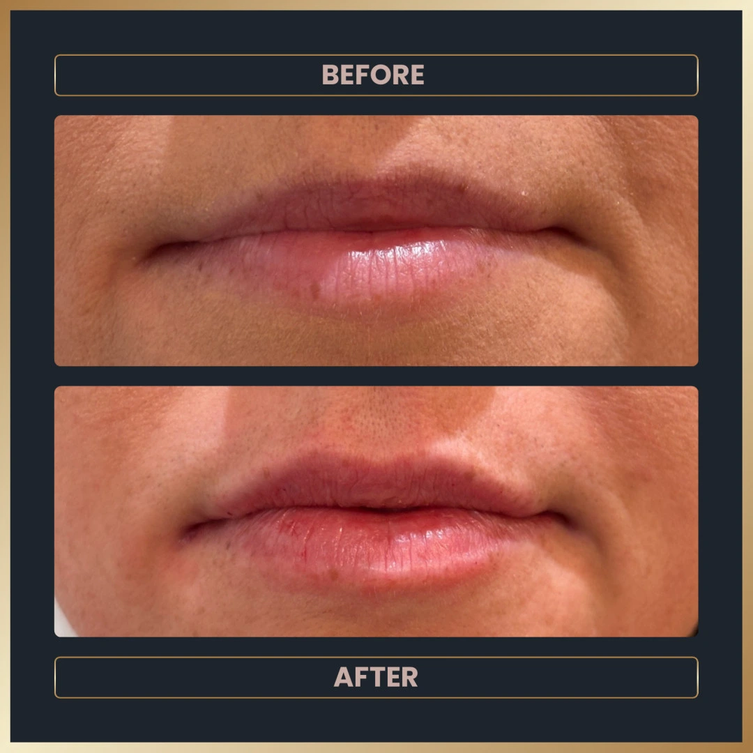 Lip filler is more than just volume