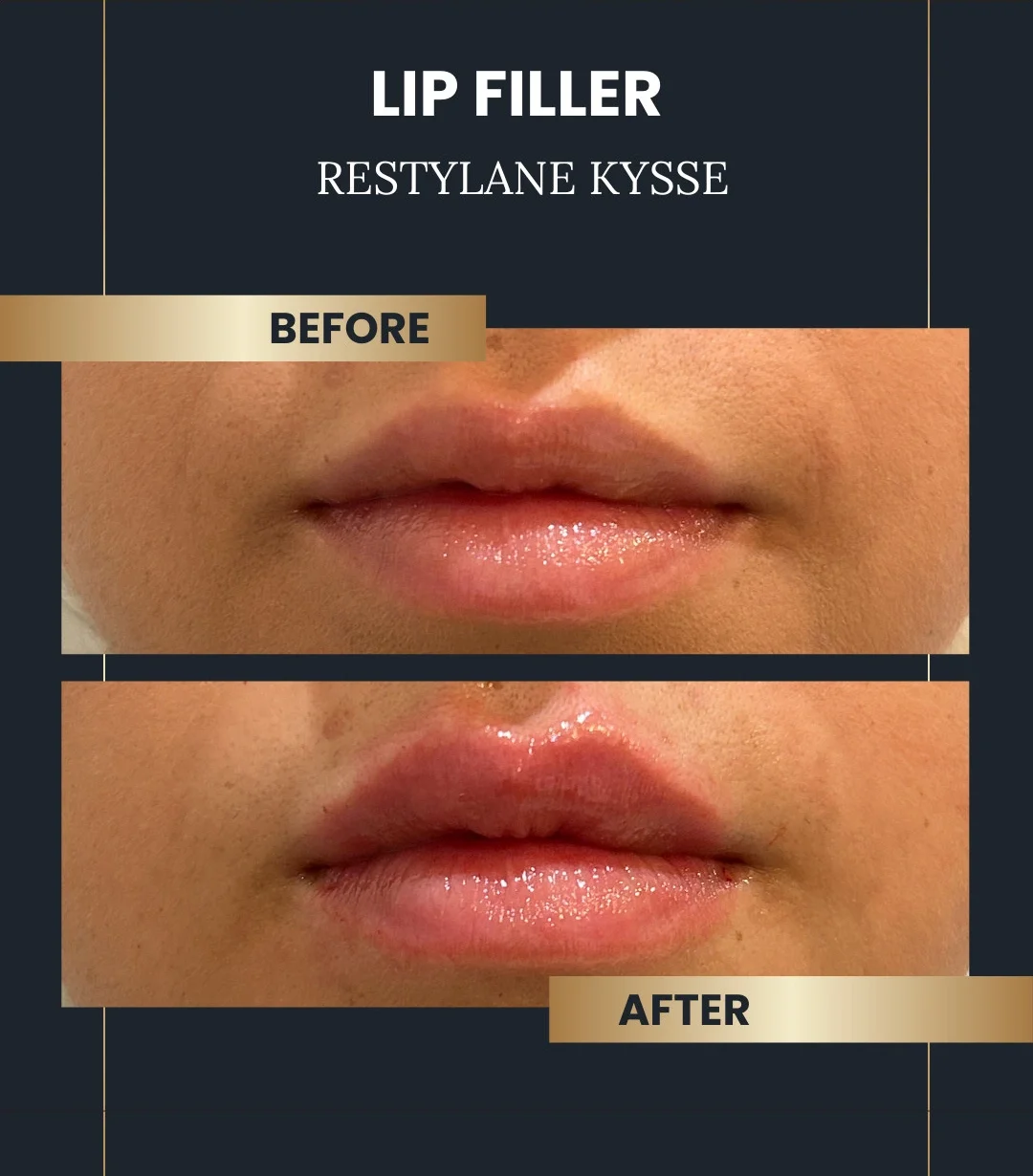 Lip fillers before and after