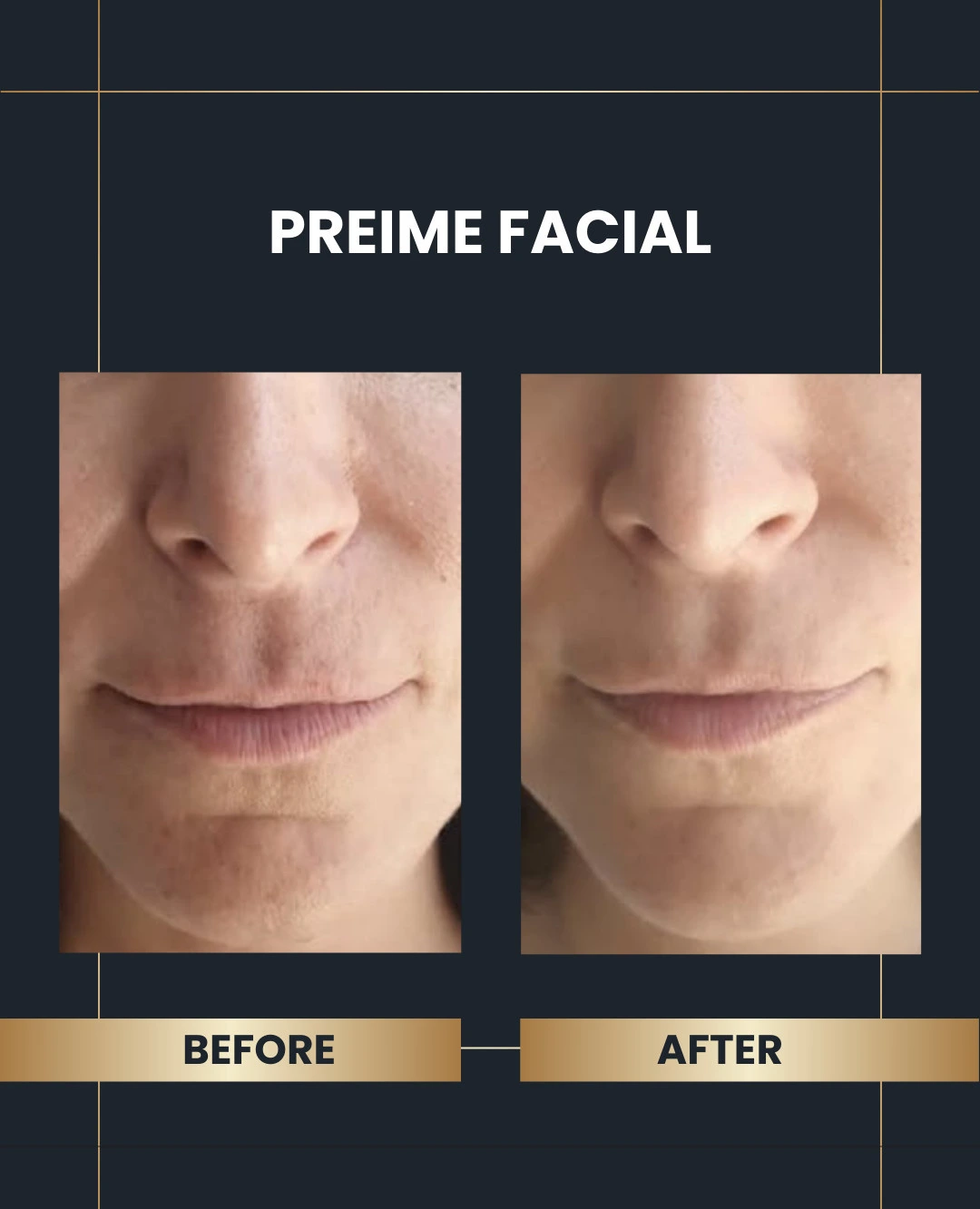 Preime Facial beore and after