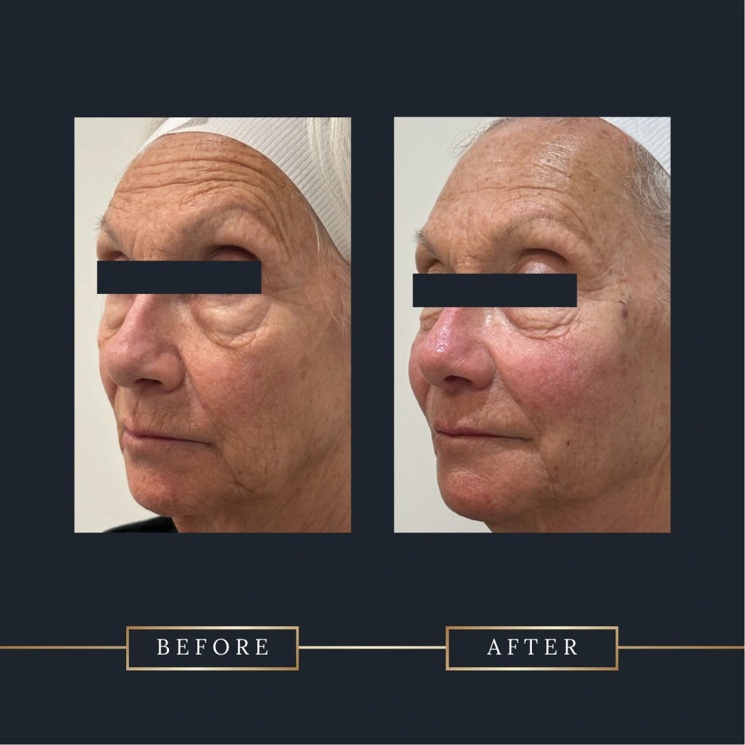 attiva before and after treatment