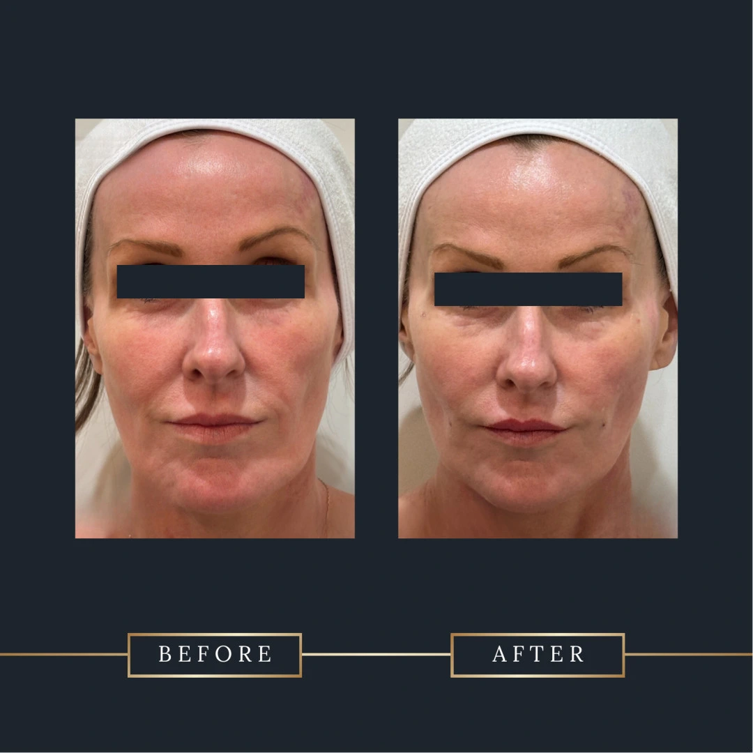 before and after attiva rye