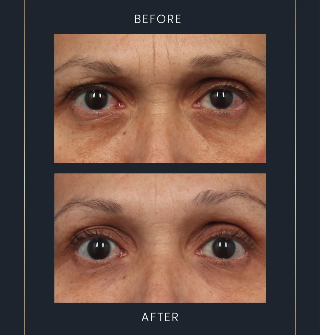 before and after emface eyes