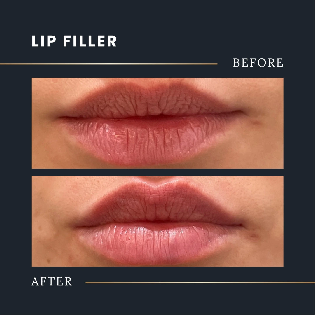 before-and-after lip filler