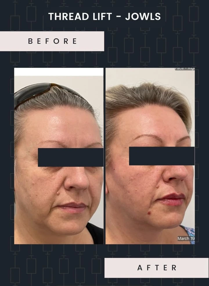 before and after thread lift