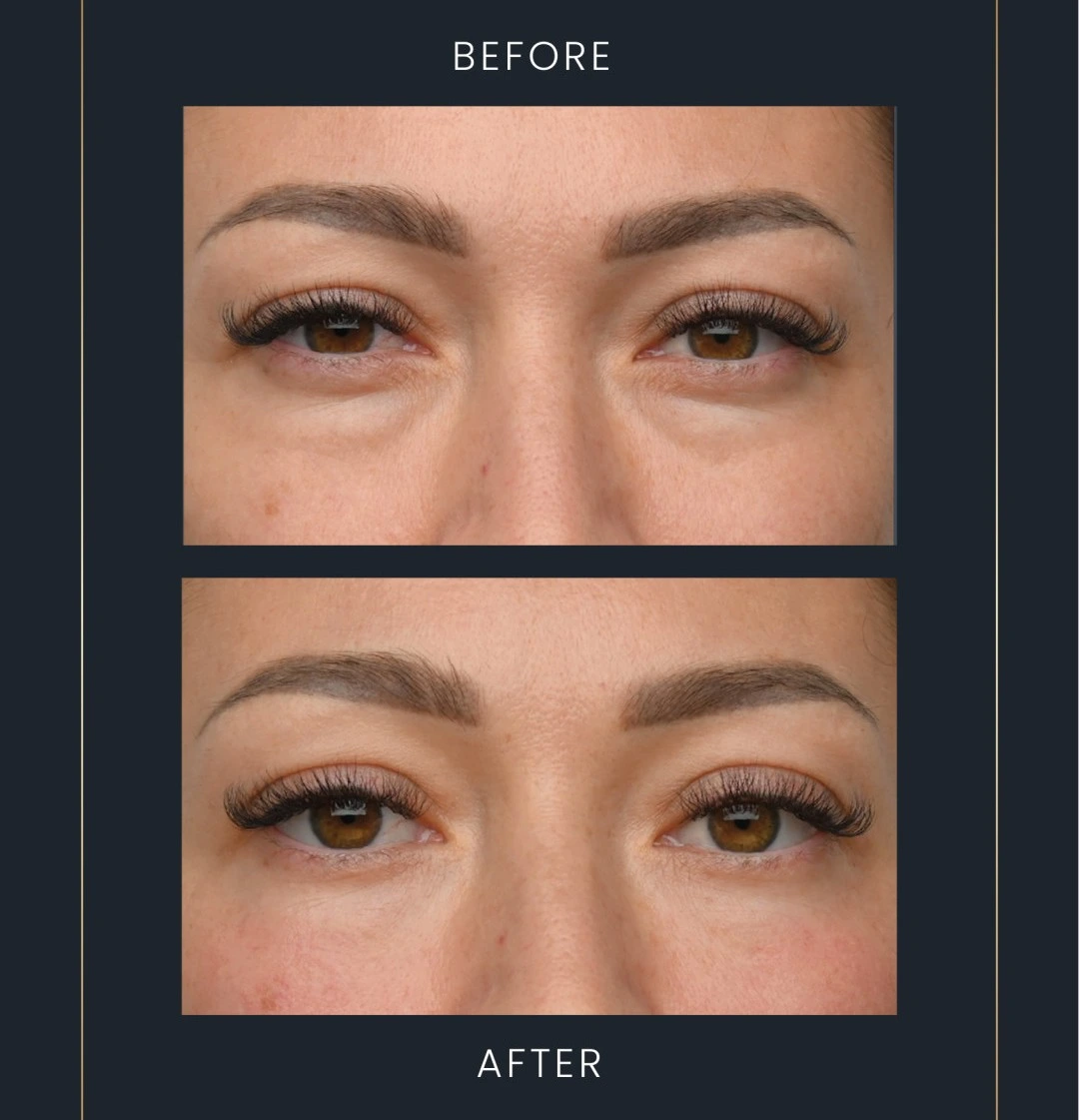 emface eyes before and after