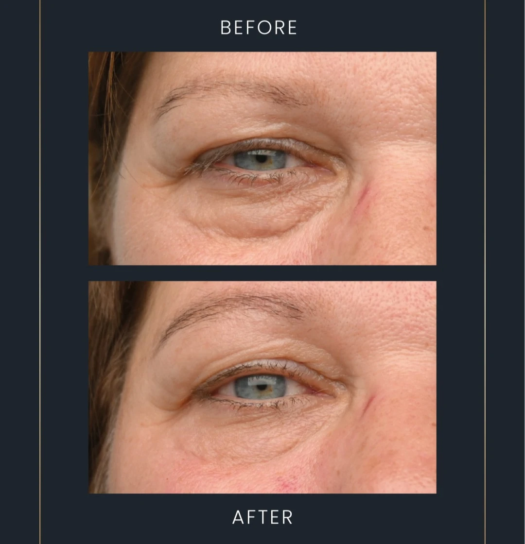 emface eyes results