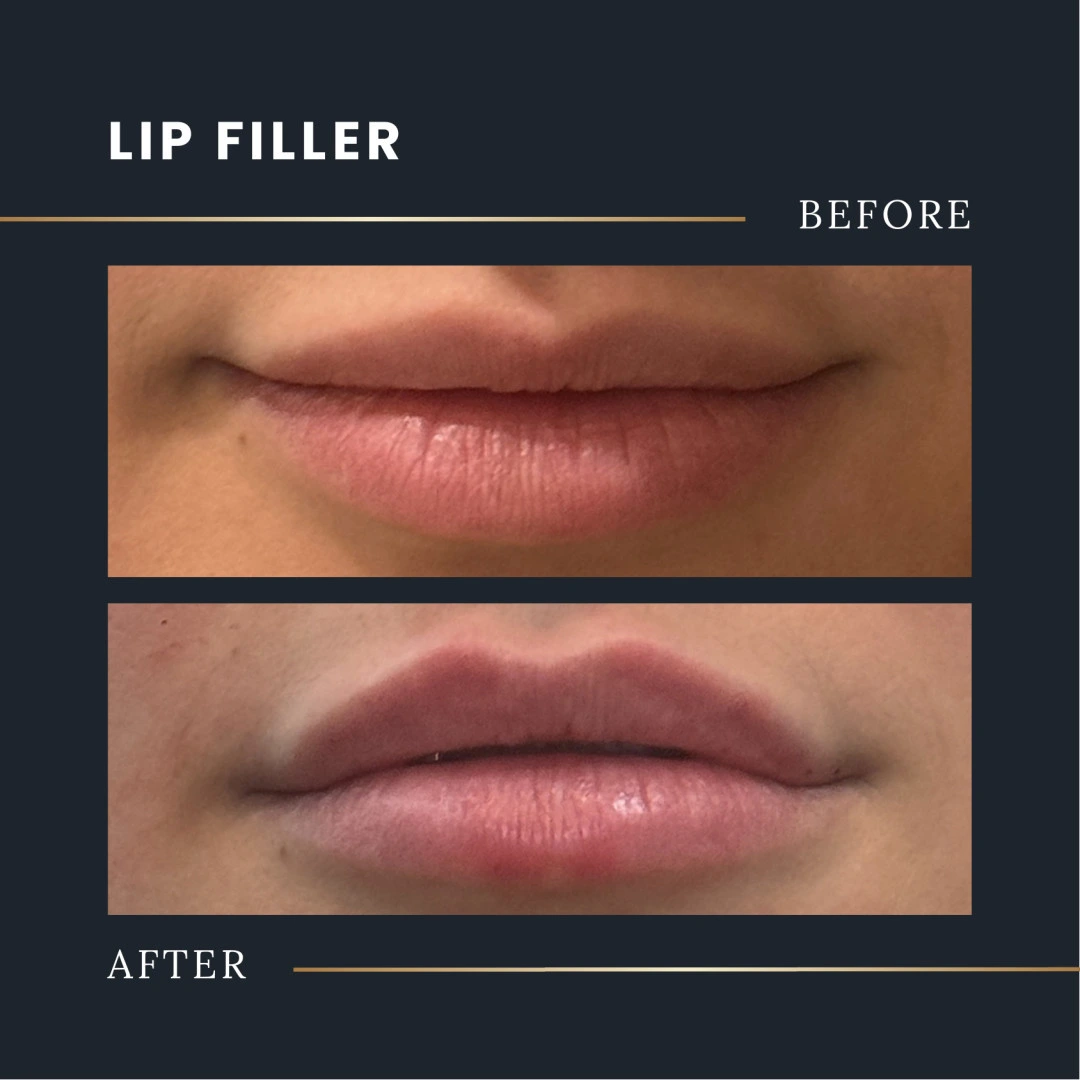 lip filler before and after