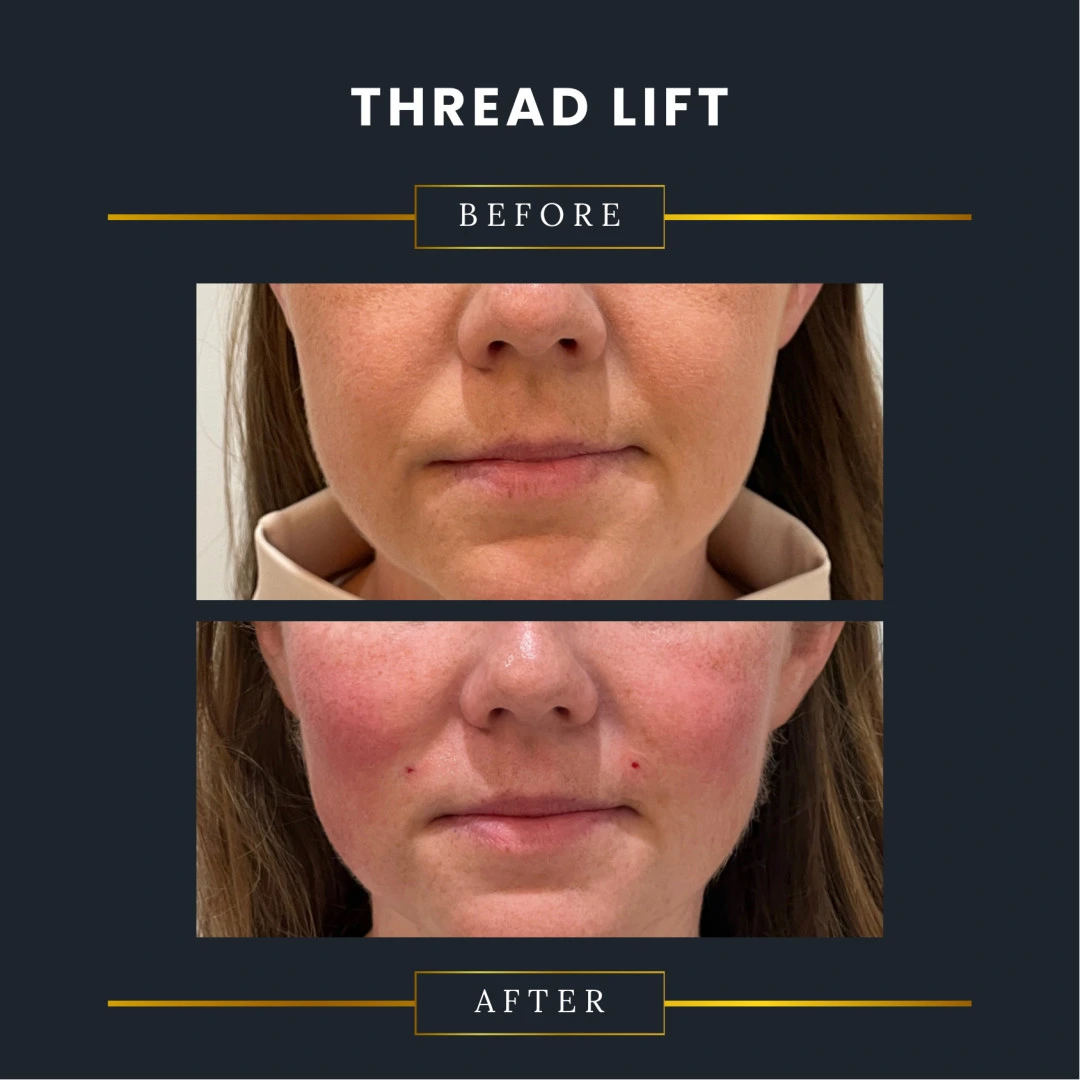 thread lift before and after
