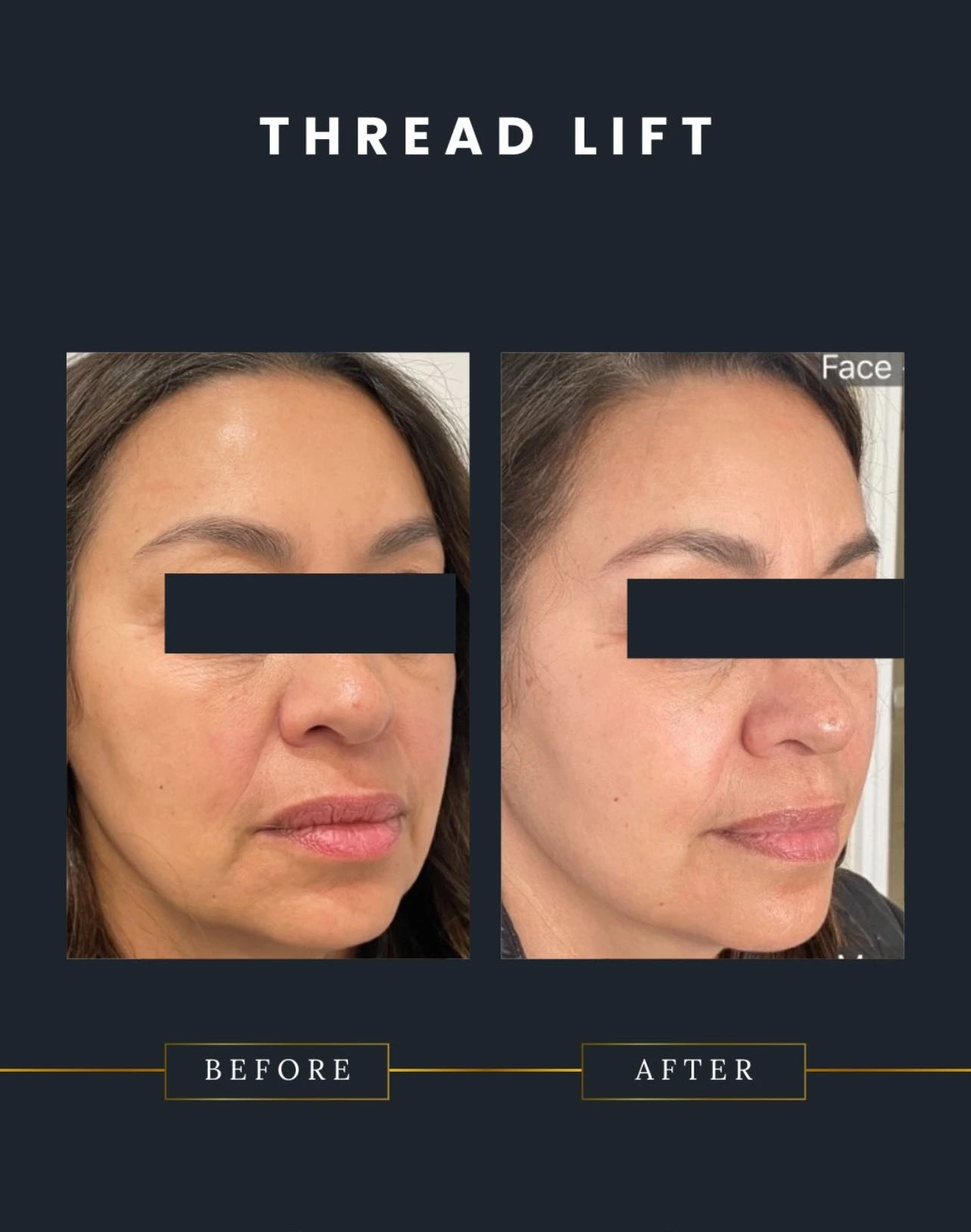 thread lift result