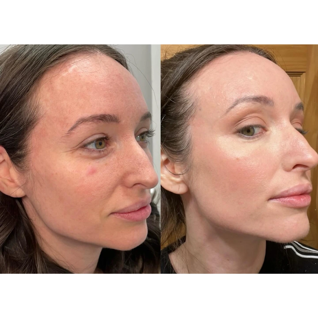 Before and After Microneedling 3