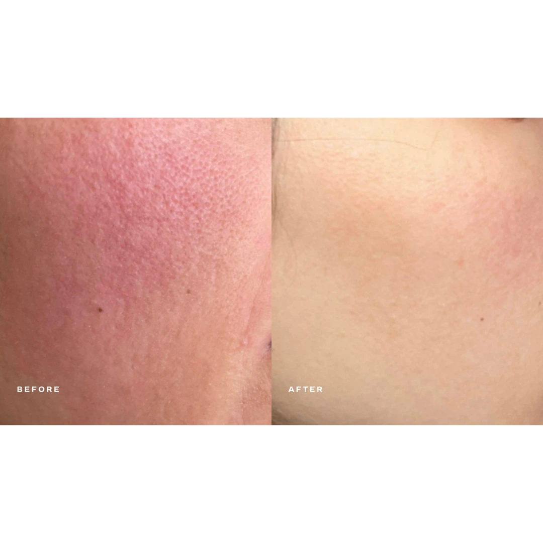 Before and After microneedling 2