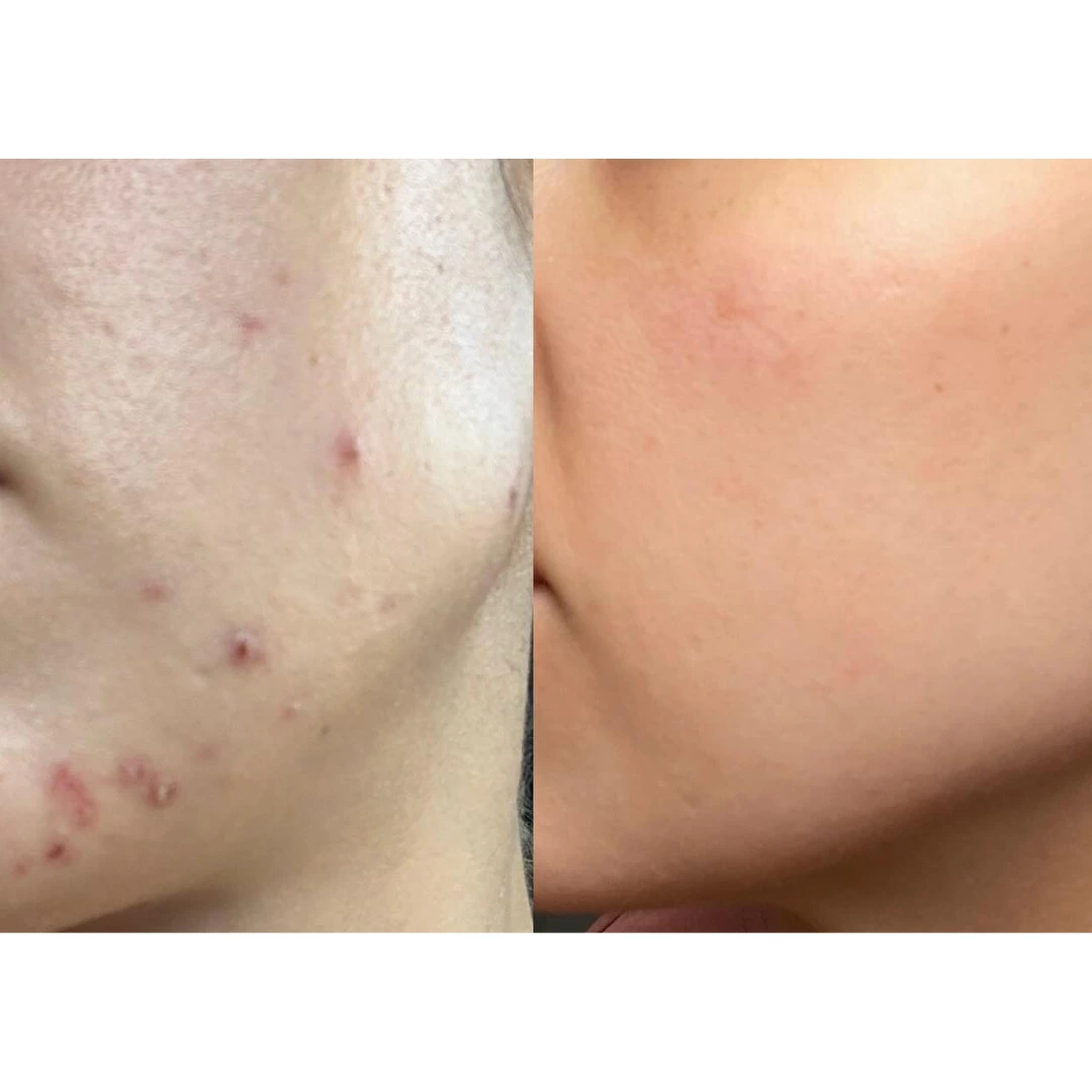 Before aned After Microneedling