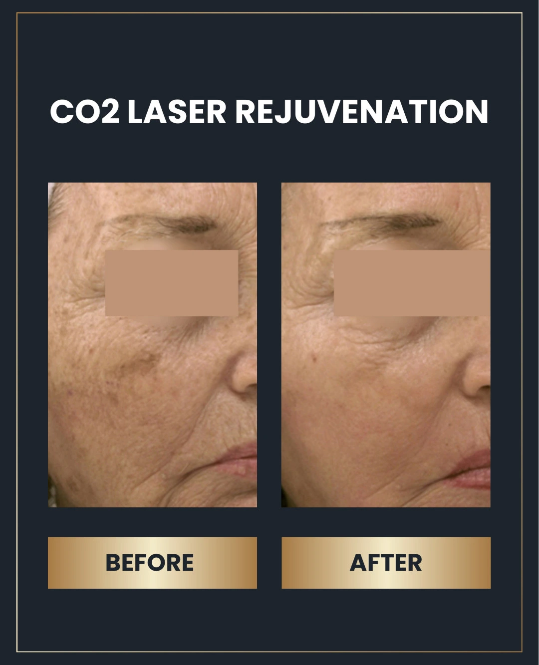 CO₂ Laser Rejuvenation