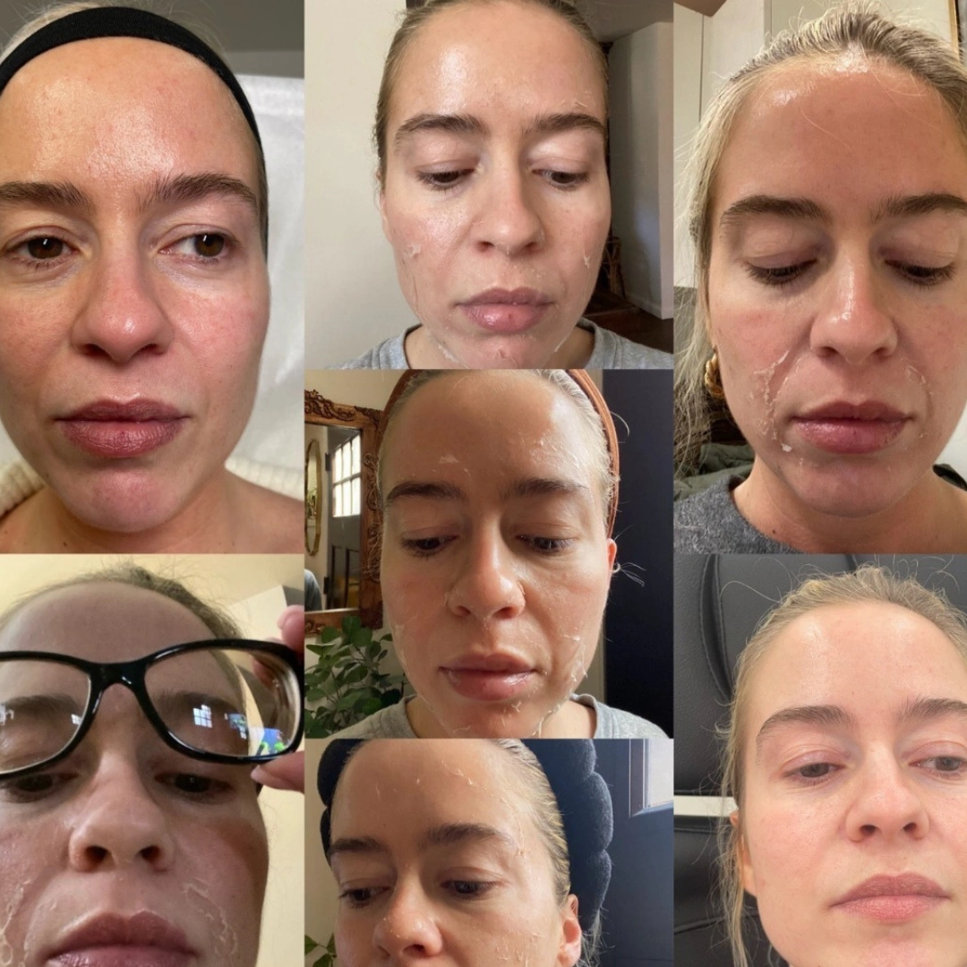 Chemical Peel Images (1)