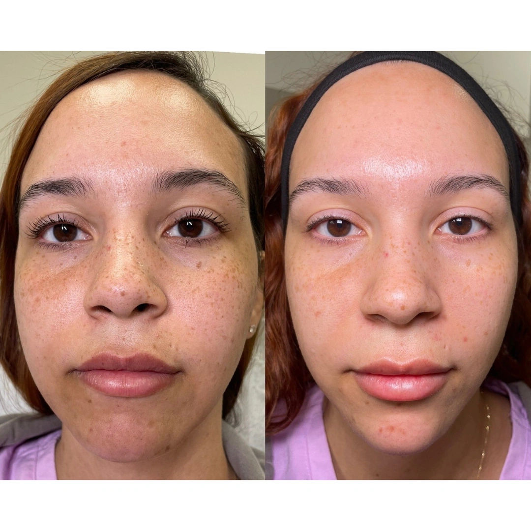 Chemical Peel Images (2)