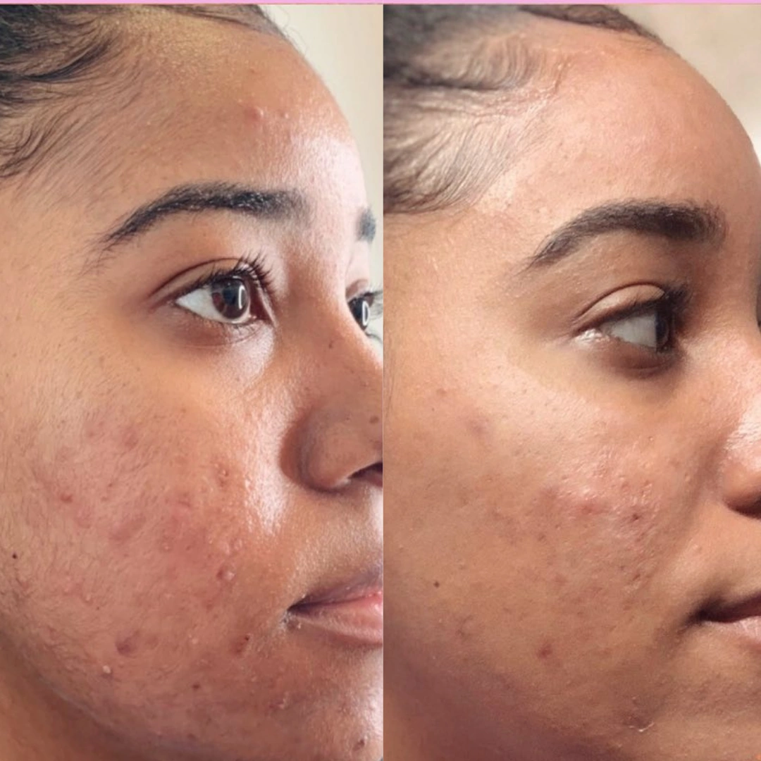 Chemical Peel Images (3)