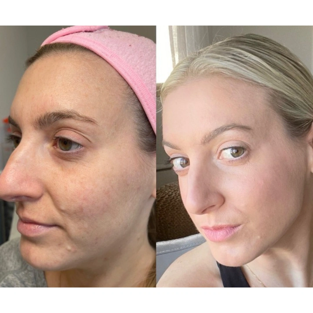 Chemical Peel Images (4)