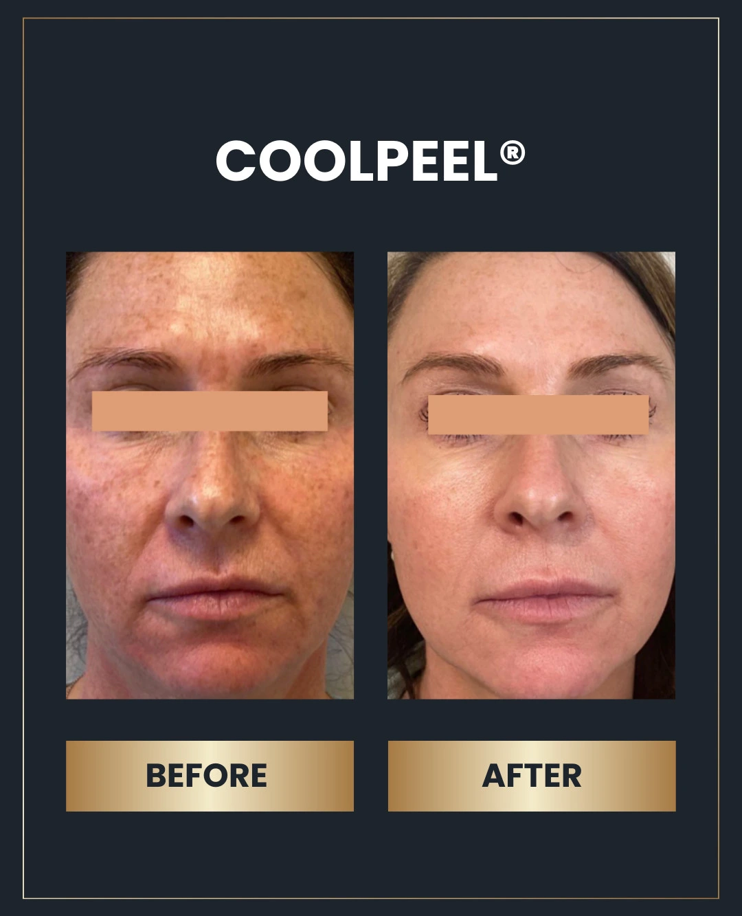 CoolPeel before and after treatment