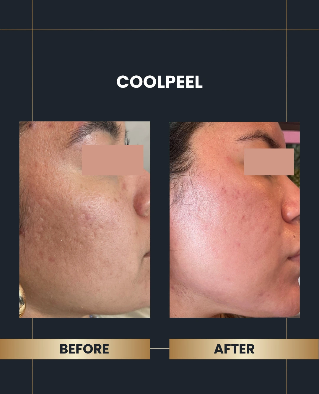 CoolPeel co2 before and after