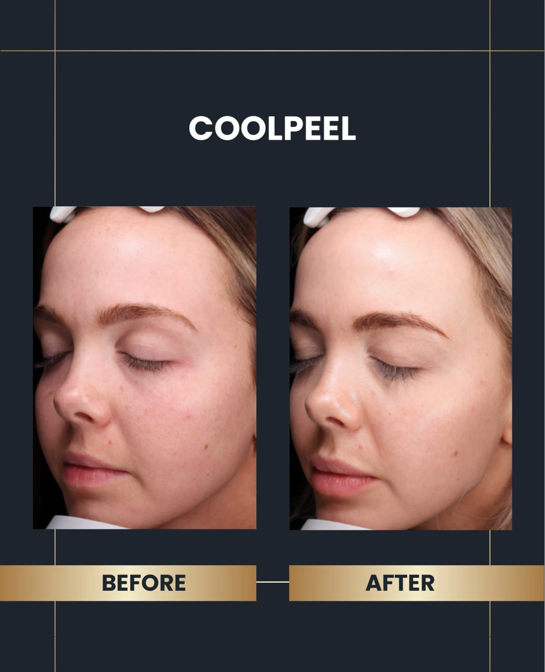 CoolPeel result