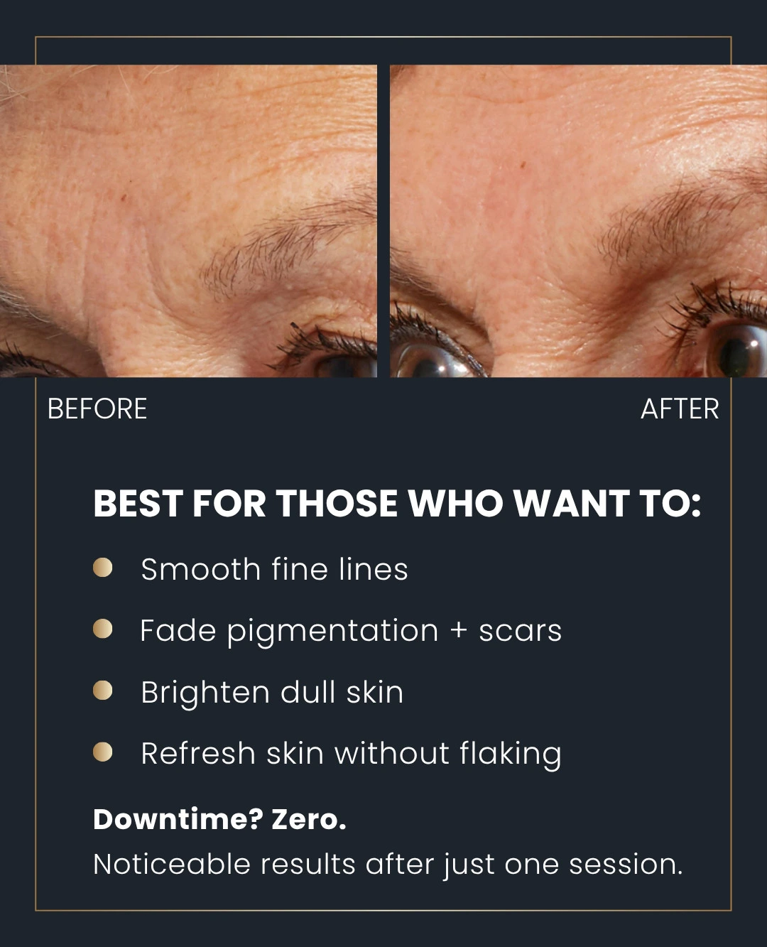 PRX Perfexion Peel 3