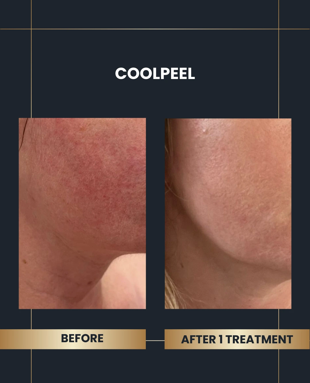 after CoolPeel