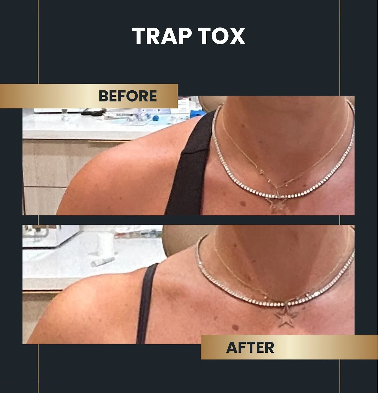 before and after trap tox