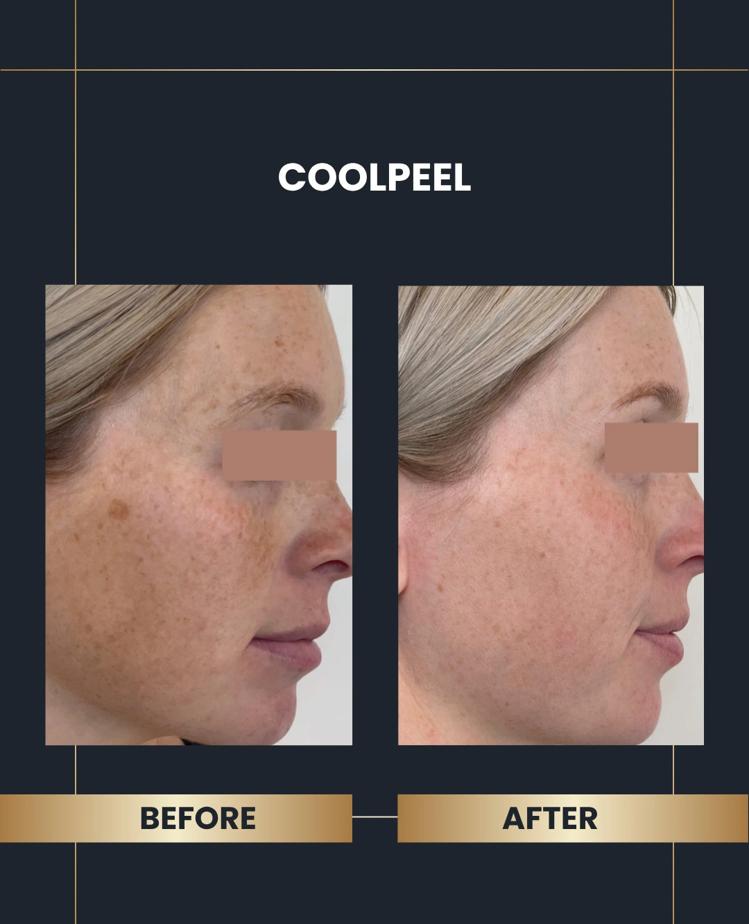 coolpeelbeforeandafter