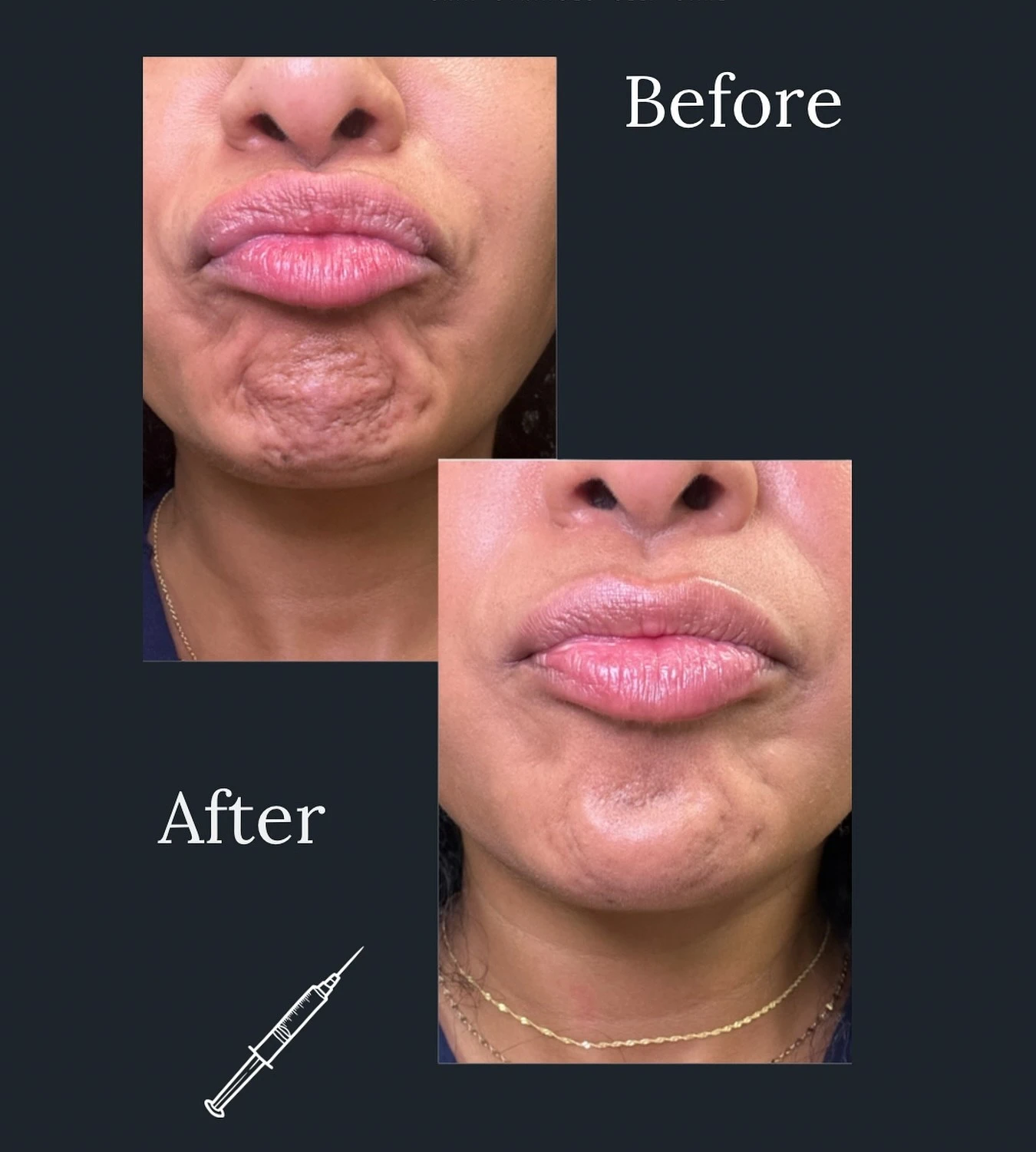 tox treatment result rye